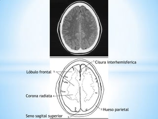 Seno sagital superior 
Corona radiata 
Hueso parietal 
Lóbulo frontal 
Cisura interhemisferica  