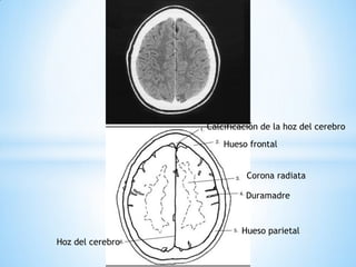 Calcificación de la hoz del cerebro 
Hueso frontal 
Hoz del cerebro 
Hueso parietal 
Corona radiata 
Duramadre  