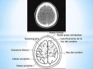 Hueso frontal 
Tejido graso retrobulbar 
Calcificaciones de la 
hoz del cerebro 
Hoz del cerebro 
Hueso occipital 
Sustancia blanca 
Lóbulo occipital 
Sustancia gris  