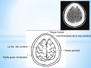 La hoz del cerebro 
Hueso parietal 
Hueso frontal 
Tejido graso retrobulbar 
Calcificaciones de la hoz cerebral  