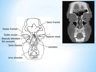 Seno frontal 
Globo ocular 
Musculo elevador Del parpado 
Seno maxilar 
Arco alveolar 
Septum nasal 
Hueso frontal 
cornetes  