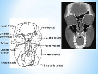 Globo ocular 
Seno maxilar 
Seno frontal 
Hueso frontal 
Tabique nasal 
Cornete nasal 
inferior 
septum nasal 
Celdillas etmoidales 
Arco alveolar 
Base de la lengua  