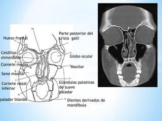 Globo ocular 
Maxilar 
Cornete nasal 
inferior 
paladar blando 
Dientes derivados de mandíbula 
Glándulas palatinas de suave paladar 
Seno maxilar 
Parte posterior del crista galli 
Hueso frontal 
Celdillas 
etmoidales 
Cornete medio  