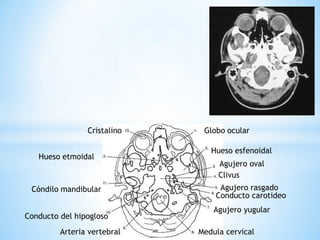 Globo ocular 
Cristalino 
Medula cervical 
Hueso etmoidal 
Hueso esfenoidal 
Agujero oval 
Clivus 
Agujero rasgado 
Conducto carotideo 
Agujero yugular 
Arteria vertebral 
Conducto del hipogloso 
Cóndilo mandibular  