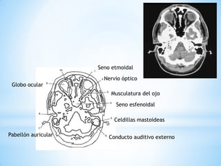 Seno etmoidal 
Nervio óptico 
Musculatura del ojo 
Seno esfenoidal 
Celdillas mastoideas 
Conducto auditivo externo 
Pabellón auricular 
Globo ocular  
