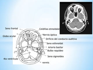 Celdillas etmoidales 
Nervio óptico 
Orificio del conducto auditivo 
Seno esfenoidal 
Arteria basilar 
Bulbo raquídeo 
Seno sigmoidea 
vermis 
4to ventrículo 
Globo ocular 
Seno frontal  