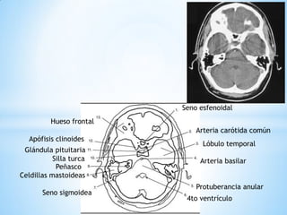 4to ventrículo 
Protuberancia anular 
Lóbulo temporal 
Seno esfenoidal 
Arteria carótida común 
Arteria basilar 
Seno sigmoidea 
Celdillas mastoideas 
Peñasco 
Silla turca 
Glándula pituitaria 
Apófisis clinoides 
Hueso frontal  