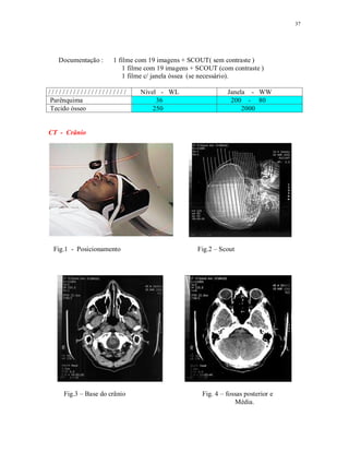 37
Documentação : 1 filme com 19 imagens + SCOUT( sem contraste )
1 filme com 19 imagens + SCOUT (com contraste )
1 filme c/ janela óssea (se necessário).
/ / / / / / / / / / / / / / / / / / / / / / Nível - WL Janela - WW
Parênquima 36 200 - 80
Tecido ósseo 250 2000
CT - Crânio
Fig.1 - Posicionamento Fig.2 – Scout
Fig.3 – Base do crânio Fig. 4 – fossas posterior e
Média.
 