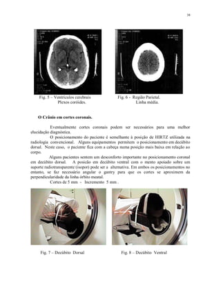 38
Fig. 5 – Ventrículos cerebrais Fig. 6 - Região Parietal.
Plexos coróides. Linha média.
O Crânio em cortes coronais.
Eventualmente cortes coronais podem ser necessários para uma melhor
elucidação diagnóstica.
O posicionamento do paciente é semelhante à posição de HIRTZ utilizada na
radiologia convencional. Alguns equipamentos permitem o posicionamento em decúbito
dorsal. Neste caso, o paciente fica com a cabeça numa posição mais baixa em relação ao
corpo.
Alguns pacientes sentem um desconforto importante no posicionamento coronal
em decúbito dorsal. A posicão em decúbito ventral com o mento apoiado sobre um
suporte radiotransparente (isopor) pode ser a alternativa. Em ambos os posicionamentos no
entanto, se faz necessário angular o gantry para que os cortes se aproximem da
perpendicularidade da linha órbito meatal.
Cortes de 5 mm - Incremento 5 mm .
Fig. 7 – Decúbito Dorsal Fig. 8 – Decúbito Ventral
 
