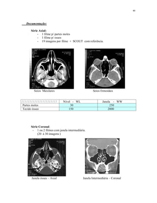 40
Documentação:
Série Axial:
- 1 filme p/ partes moles
- 1 filme p/ ossos
- 19 imagens por filme + SCOUT com referência.
Seios Maxilares Seios Etmoidais
/ / / / / / / / / / / / / / / / / / / / / / Nível - WL Janela - WW
Partes moles 30 250
Tecido ósseo 150 2000
Série Coronal:
- 1 ou 2 filmes com janela intermediária.
(20 à 30 imagens )
Janela óssea – Axial Janela Intermediária – Coronal
 