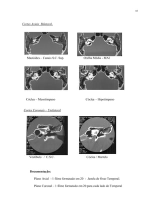 43
Cortes Axiais Bilateral.
Mastóides – Canais S.C. Sup. Orelha Média - MAI
Cóclea – Mesotímpano Cóclea – Hipotímpano
Cortes Coronais – Unilateral
Vestíbulo / C.S.C. Cóclea / Martelo
Documentação:
Plano Axial - 1 filme formatado em 20 - Janela de Osso Temporal.
Plano Coronal – 1 filme formatado em 20 para cada lado do Temporal
 