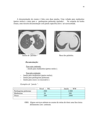 48
A documentação do exame é feita com duas janelas. Uma voltada para mediastino
(partes moles) e outra para o parênquima pulmonar (pulmão) . Na suspeita de lesões
ósseas, uma terceira documentação com janela específica deve ser acrescentada.
Janela de “pulmão “ Base dos pulmões.
Documentação:
Fase sem contraste:
- Janela para mediastino (partes moles ).
Fase pós contraste:
- Janela para mediastino (partes moles).
- Janela para parênquima pulmonar.
- Janela para ossos ( se necessário ).
Exemplos de “janela “.
/ / / / / / / / / / / / / / / / / / / / / / Nível - WL Janela - WW
Parênquima pulmonar - 800 2.000
Mediastino 30 300
Ossos 200 2000
OBS: Alguns serviços adotam no exame de rotina do tórax uma fase única
diretamente com contraste.
 