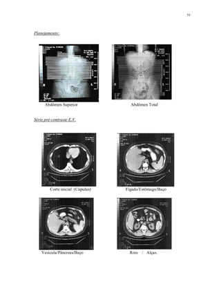 53
Planejamento:
Abdômen Superior Abdômen Total
Série pré-contraste E.V.
Corte inicial (Cúpulas) Fígado/Estômago/Baço
Vesícula/Pâncreas/Baço Rins / Alças.
 