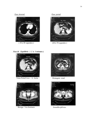 54
Fase Arterial Fase portal
( 30 à 40 segundos ) (60 à 70 segundos )
Fase de Equilibrio ( 2 à 3 minutos )
Veias Porta/Cava - A. Aorta Drenagem renal
Bexiga / Ves.Seminais Assoalho pélvico.
 
