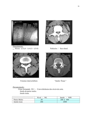 58
Planejamento:
Níveis L3-L4 / L4-L5 / L5-S1 Pedículos / Saco dural.
Forames intervertebrais “Janela Óssea “
Documentação:
Filme formatado 20:1 - Com referências dos níveis de corte.
Janela de partes moles.
Janela óssea.
/ / / / / / / / / / / / / / / / / / / / / / Nível - WL Janela - WW
Partes Moles 30 200 à 400
Janela óssea 200 2000
 