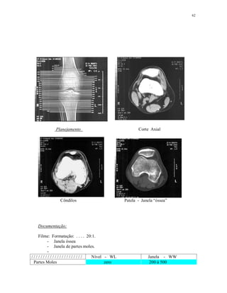 62
Planejamento Corte Axial
Côndilos Patela - Janela “óssea”
Documentação:
Filme: Formatação: . . . . 20:1.
- Janela óssea
- Janela de partes moles.
-
/ / / / / / / / / / / / / / / / / / / / / / Nível - WL Janela - WW
Partes Moles zero 200 à 500
 