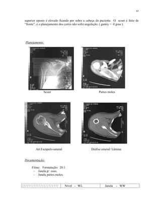 65
superior oposto é elevado ficando por sobre a cabeça do paciente. O scout é feito de
“frente”, e o planejamento dos cortes não sofre angulação. ( gantry = 0 grau ).
Planejamento:
Scout Partes moles
Art.Escápulo-umeral Diáfise umeral/ Lâmina
Documentação:
Filme: Formatação: 20:1
- Janela p/ osso.
- Janela partes moles.
/ / / / / / / / / / / / / / / / / / / / / / Nível - WL Janela - WW
 