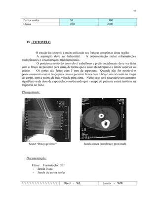66
Partes moles 50 300
Ossos 200 2000
15 . COTOVELO
O estudo do cotovelo é muito utilizado nas fraturas complexas desta região.
A aquisição deve ser helicoidal. A documentação inclui reformatações
multiplanares e reconstruções tridimensionais.
O posicionamento do cotovelo é trabalhoso e preferencialmente deve ser feito
com o braço do paciente para cima, de forma que o cotovelo ultrapasse o limite superior do
crânio. Os cortes são feitos com 3 mm de espessura. Quando não for possível o
posicionamento com o braço para cima o paciente ficará com o braço em extensão ao longo
do corpo, com a palma da mão voltada para cima. Neste caso será necessário um aumento
significativo da dose de exposição, considerando que o corpo do paciente estará também na
trejetória do feixe.
Planejamento:
Scout “Braço p/cima “ Janela óssea (antebraço proximal).
Documentação:
Filme: Formatação: 20:1
- Janela óssea
- Janela de partes moles
/ / / / / / / / / / / / / / / / / / / / / / Nível - WL Janela - WW
 