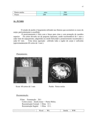 67
Partes moles zero 200
Ossos 200 2000
16 . PUNHO
O estudo do punho é largamente utilizado nas fraturas que acometem os ossos do
carpo, particularmente o escafóide.
O posicionamento é feito com o braço para cima e com pronação do membro
superior. Os cortes deverão ser de pequena espessura, sendo recomendável de 1 mm a
cada 1mm de espaçamento, adquiridos no modo helicoidal e posteriormente recontruídos a
cada 0,5 mm. Uma única aquisição cobrindo toda a região do carpo é suficiente
(aproximadamente 60 cortes de 1 mm ).
Planejamento:
Scout 60 cortes de 1 mm Punho: Partes moles
Documentação:
Filme: Formatação: 20:1
Cortes axiais: Janela óssea + Partes Moles.
Reconstrução Coronal: 1 filme 12:1.
Reconstrução Sagital: 1 filme 12:1.
/ / / / / / / / / / / / / / / / / / / / / / Nível - WL Janela - WW
 