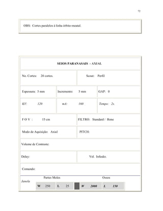 72
OBS: Cortes paralelos à linha órbito-meatal.
SEIOS PARANASAIS - AXIAL
No. Cortes: 20 cortes. Scout: Perfil
Espessura: 5 mm Incremento: 5 mm GAP: 0
KV: 120 mA: 160 Tempo: 2s.
F O V : 15 cm FILTRO: Standard / Bone
Modo de Aquisição: Axial PITCH:
Volume de Contraste:
Delay: Vel. Infusão.
Comando:
Partes Moles Ossos
Janela
W 250 L 25 W 2000 L 150
 