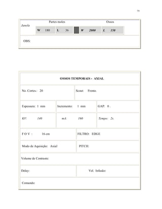 75
Partes moles Ossos
Janela
W 180 L 36 W 2000 L 150
OBS:
OSSOS TEMPORAIS - AXIAL
No. Cortes.: 20 Scout: Frente.
Espessura: 1 mm Incremento: 1 mm GAP: 0 .
KV: 140 mA: 160 Tempo: 2s.
F O V : 16 cm FILTRO: EDGE
Modo de Aquisição: Axial PITCH:
Volume de Contraste:
Delay: Vel. Infusão:
Comando:
 