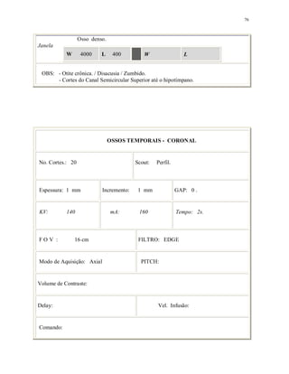 76
Osso denso.
Janela
W 4000 L 400 W L
OBS: - Otite crônica. / Disacusia / Zumbido.
- Cortes do Canal Semicircular Superior até o hipotímpano.
OSSOS TEMPORAIS - CORONAL
No. Cortes.: 20 Scout: Perfil.
Espessura: 1 mm Incremento: 1 mm GAP: 0 .
KV: 140 mA: 160 Tempo: 2s.
F O V : 16 cm FILTRO: EDGE
Modo de Aquisição: Axial PITCH:
Volume de Contraste:
Delay: Vel. Infusão:
Comando:
 