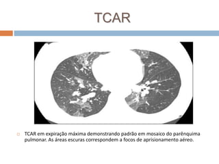 TCAR




   TCAR em expiração máxima demonstrando padrão em mosaico do parênquima
    pulmonar. As áreas escuras correspondem a focos de aprisionamento aéreo.
 