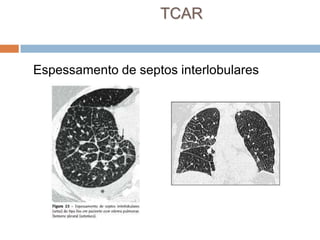TCAR


Espessamento de septos interlobulares
 