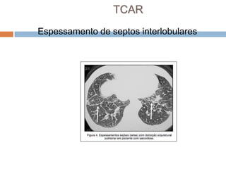 TCAR
Espessamento de septos interlobulares
 