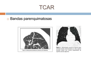 TCAR
   Bandas parenquimatosas
 