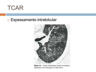 TCAR
   Espessamento intralobular
 