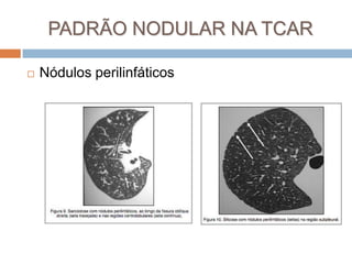 PADRÃO NODULAR NA TCAR

   Nódulos perilinfáticos
 