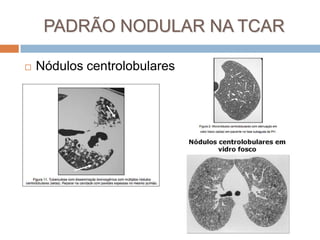 PADRÃO NODULAR NA TCAR

   Nódulos centrolobulares
 
