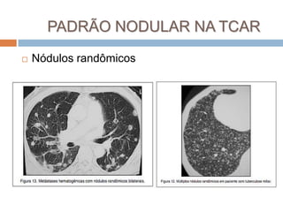 PADRÃO NODULAR NA TCAR
   Nódulos randômicos
 