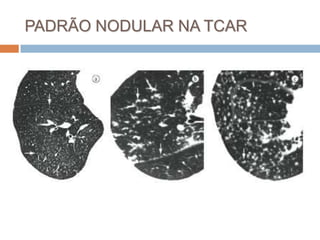 PADRÃO NODULAR NA TCAR
 