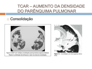TCAR – AUMENTO DA DENSIDADE
       DO PARÊNQUIMA PULMONAR
   Consolidação
 