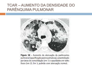 TCAR – AUMENTO DA DENSIDADE DO
PARÊNQUIMA PULMONAR
 