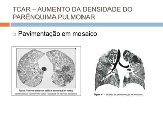 TCAR – AUMENTO DA DENSIDADE DO
PARÊNQUIMA PULMONAR

   Pavimentação em mosaico
 