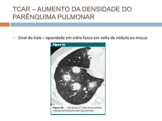 TCAR – AUMENTO DA DENSIDADE DO
PARÊNQUIMA PULMONAR


   Sinal do halo – opacidade em vidro fosco em volta de nódulo ou massa
 