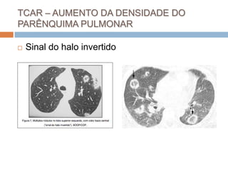 TCAR – AUMENTO DA DENSIDADE DO
PARÊNQUIMA PULMONAR

   Sinal do halo invertido
 