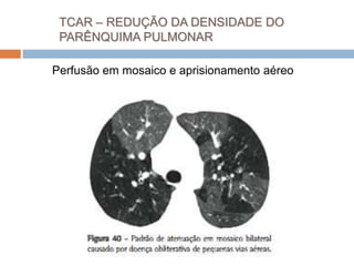 TCAR – REDUÇÃO DA DENSIDADE DO
 PARÊNQUIMA PULMONAR

Perfusão em mosaico e aprisionamento aéreo
 