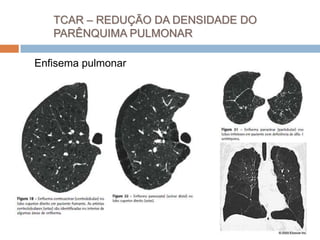 TCAR – REDUÇÃO DA DENSIDADE DO
   PARÊNQUIMA PULMONAR

Enfisema pulmonar
 