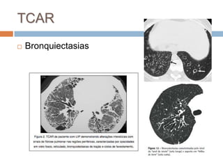 TCAR
   Bronquiectasias
 