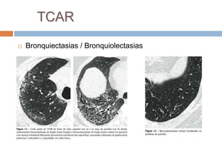TCAR
   Bronquiectasias / Bronquiolectasias
 