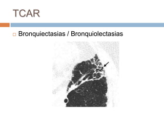 TCAR
   Bronquiectasias / Bronquiolectasias
 