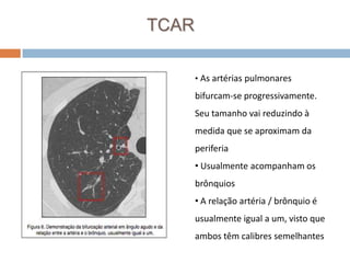 TCAR

       • As artérias pulmonares

       bifurcam-se progressivamente.
       Seu tamanho vai reduzindo à
       medida que se aproximam da
       periferia
       • Usualmente acompanham os
       brônquios
       • A relação artéria / brônquio é
       usualmente igual a um, visto que
       ambos têm calibres semelhantes
 