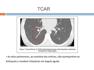 TCAR




• As veias pulmonares, ao contrário das artérias, não acompanham os

brônquios e recebem tributárias em ângulo agudo
 