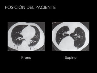 POSICIÓN DEL PACIENTE
Prono Supino
 