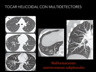 TOCAR HELICOIDAL CON MULTIDETECTORES
Malformaciones
arteriovenosas subpleurales
 