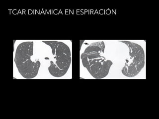 TCAR DINÁMICA EN ESPIRACIÓN
 